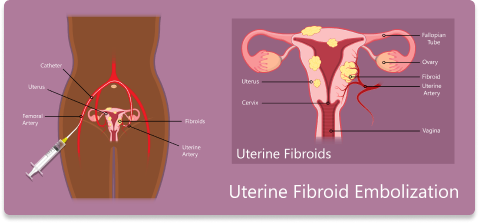 fibroid